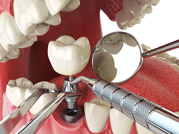 Urgent Tooth Repair in GA